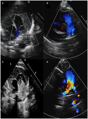 Case Report: Two Cases of Pulmonary Artery Dissection in Young Infants